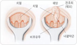 치열의 원인