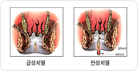 치핵