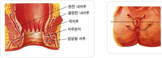 치루및 항문주위 농양