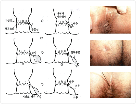 치루및 항문주위 농양의 증상
