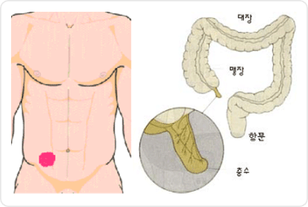 급성충수염